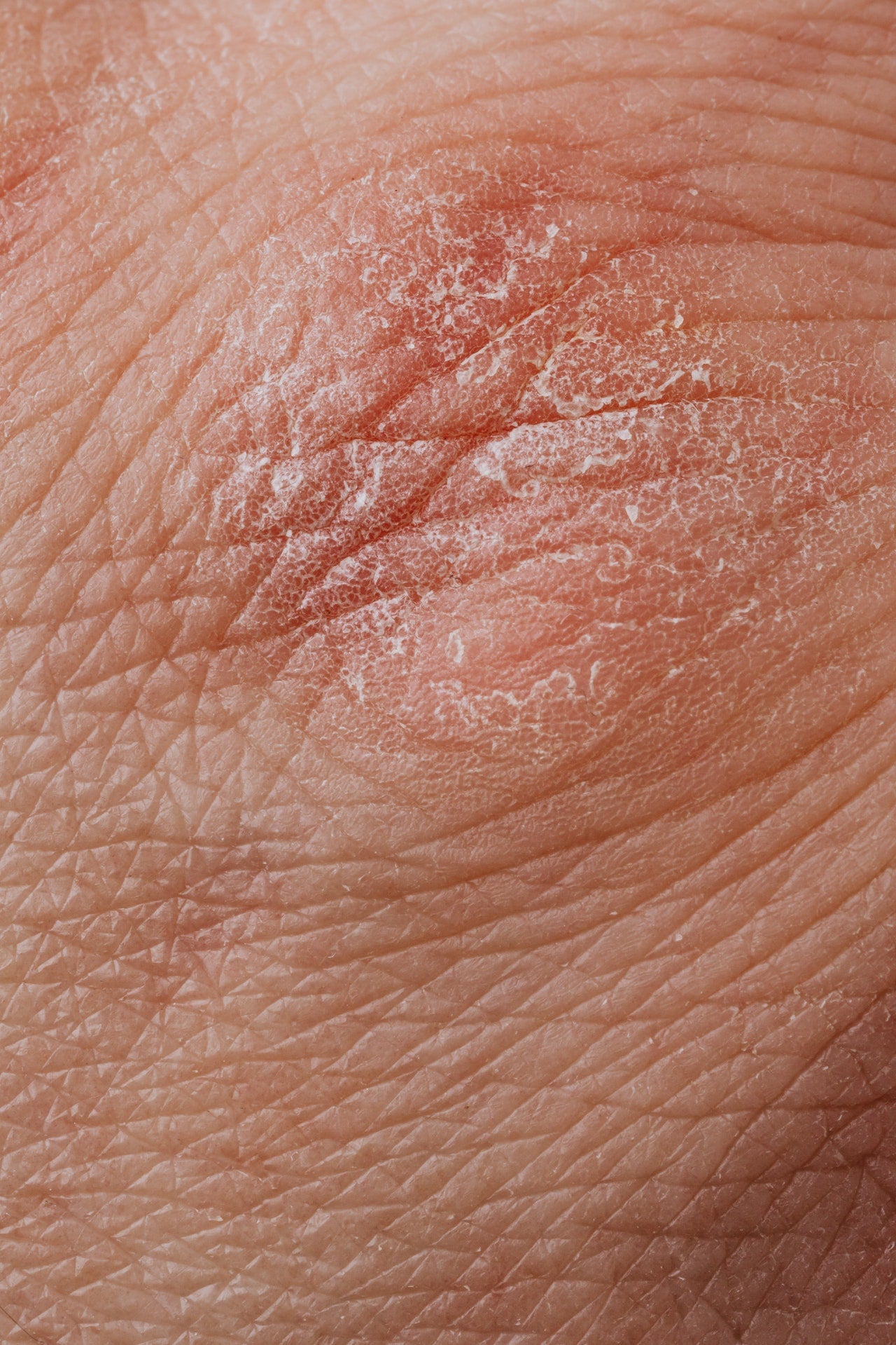 Dry Irritated Skin
